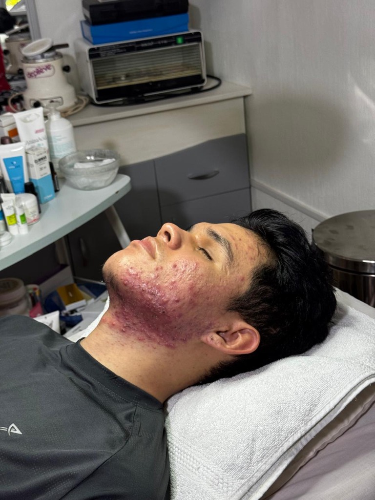 Paciente con acné severo antes de tratamiento